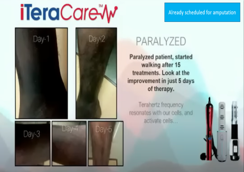 Paralyzed patiend started to walk after 15 treatment.